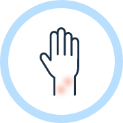 アトピー性皮膚炎